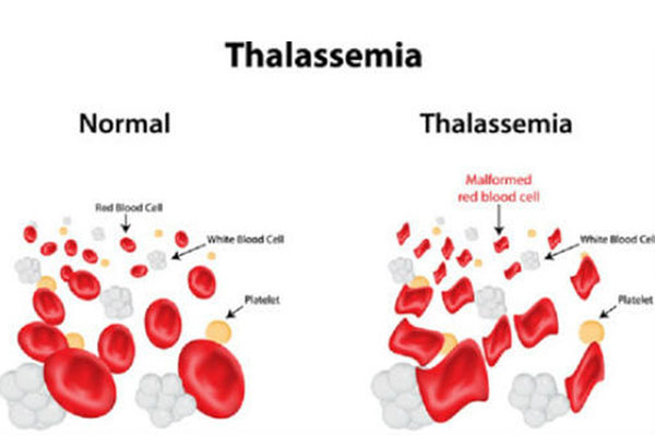 Cùng Bác sĩ Cao đẳng Dược Tphcm tìm hiểu về thiếu máu Thalassemia
