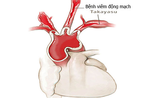 Tìm hiểu viêm động mạch Takayasu cùng giảng viên Cao đẳng Dược Sài Gòn