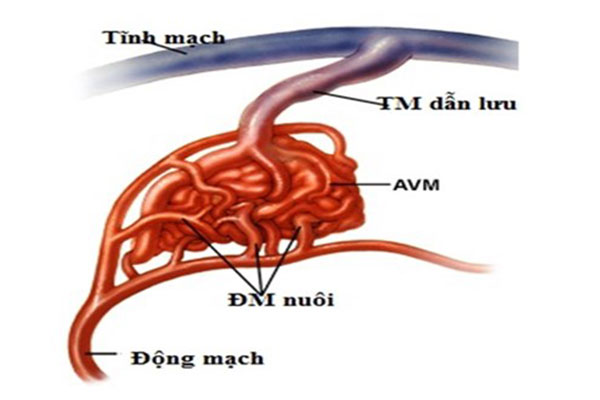 Nguyên nhân dị dạng động tĩnh mạch hiện chưa được rõ