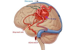 Bác sĩ Trường Cao đẳng Dược Sài Gòn nói về dị dạng động tĩnh mạch