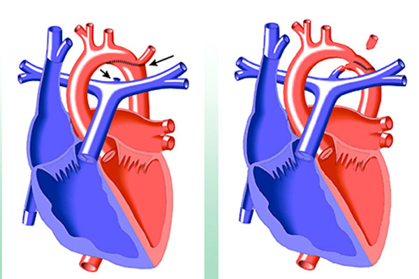 Khiếm khuyết tim bẩm sinh gây hẹp eo động mạch chủ 