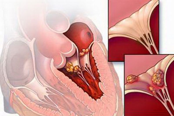 Viêm cơ tim hoặc viêm màng ngoài tim cấp tính có thể là nguyên nhân gây Block xoang nhĩ