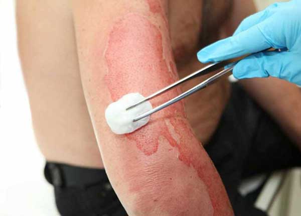 Hướng dẫn kỹ thuật sát khuẩn vùng da trong chăm sóc y tế