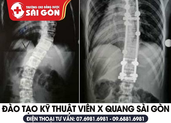 Phát hiện và điều trị bệnh u trung thất cùng với chuyên gia Dược Sài Gòn