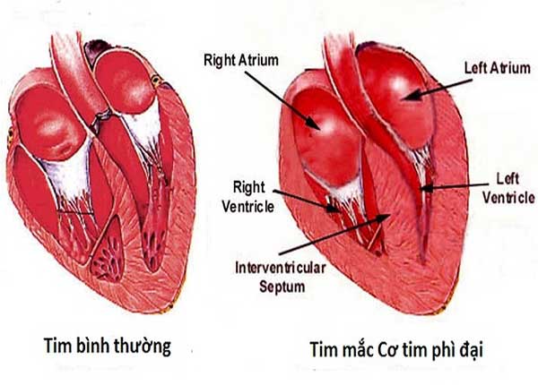 Bệnh cơ tim giãn nở thường xảy ra ở tâm thất trái