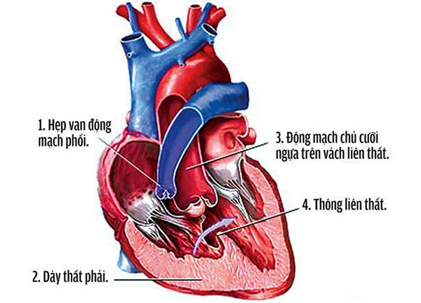 Thông liên thất là một bệnh tim bẩm sinh thường gặp