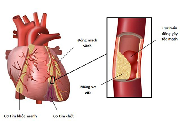 XVĐM hình thành bởi chất béo, cholesterol và các chất khác trong và trên thành động mạch (mảng bám), gây cản trở dòng máu.