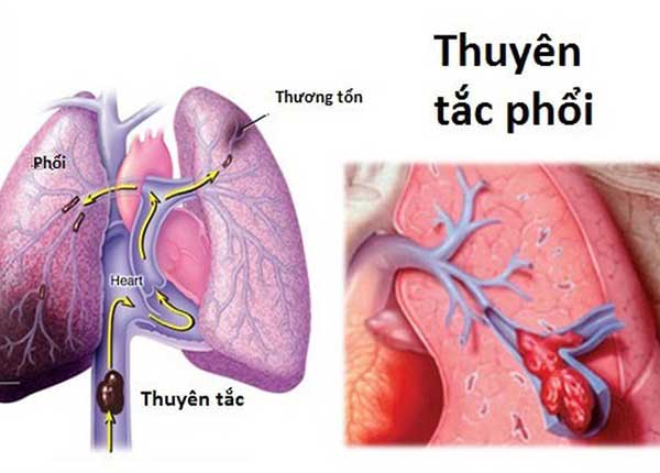 Bệnh thuyên tắc phổi có mức nguy hiểm cao chỉ sau nhồi máu cơ tim và đột quỵ