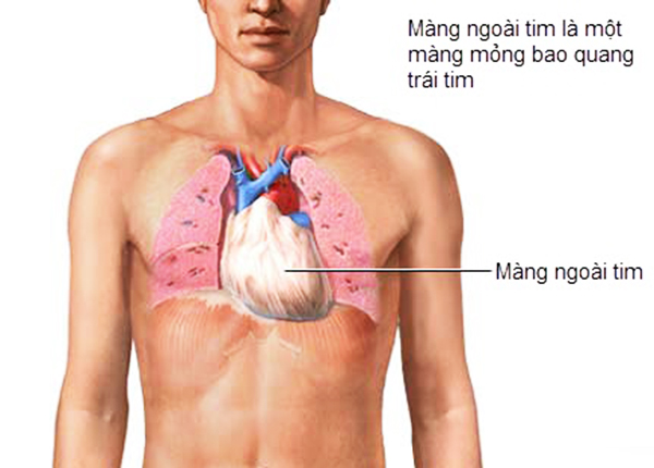 Viêm màng ngoài tim là tình trạng lớp màng bao quanh tim cấu tạo từ tế bào có hiện tượng bị kích thích và sưng phồng lên