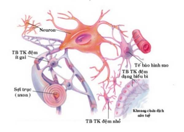 U tế bào thần kinh đệm là khối u xảy ra ở não và tủy sống