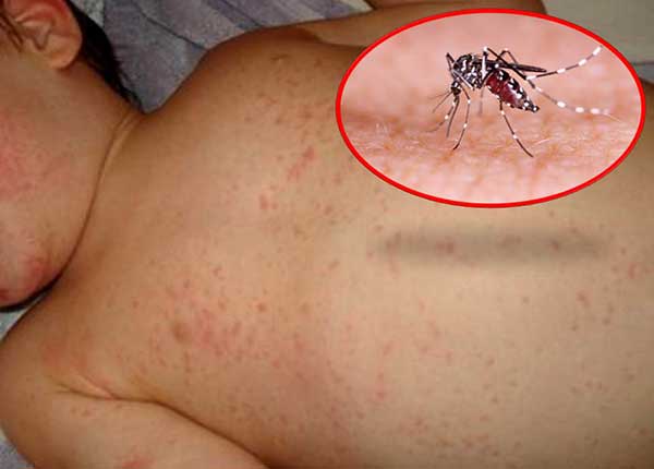 Phòng tránh bệnh sốt xuất huyết giúp bạn tránh được những biến chứng nguy hiểm