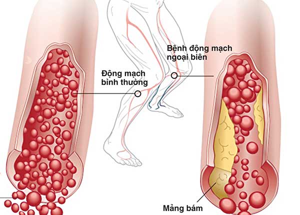 Bệnh động mạch ngoại biên thường gây ra bởi xơ vữa động mạch