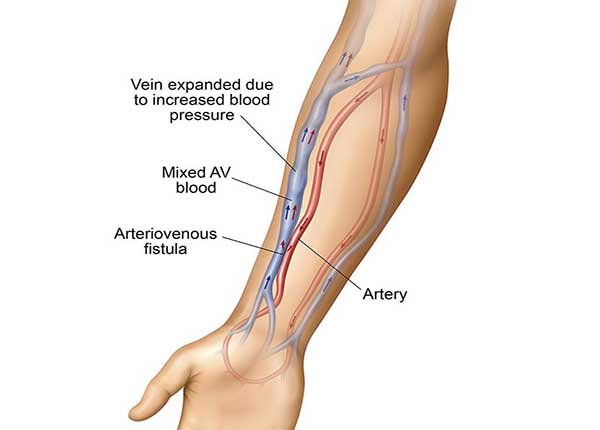 Các rò động tĩnh mạch có thể phát triển ở bất cứ đâu trong cơ thể