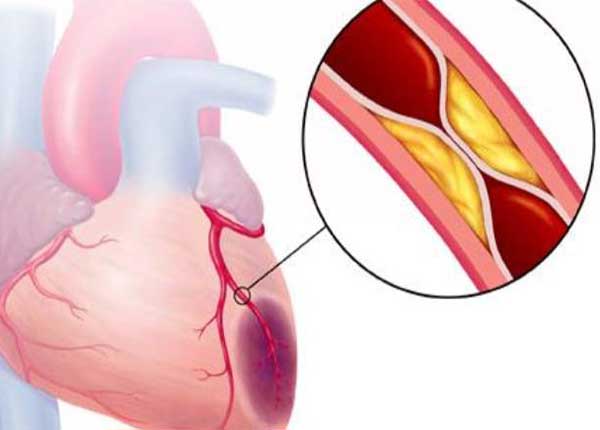 Hội chứng mạch vành cấp thường xuất phát từ sự tích tụ các lắng đọng mỡ 