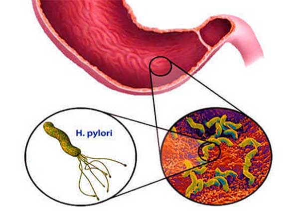 Nhiễm khuẩn HP không được chữa trị có thể gây ra ung thư dạ dày