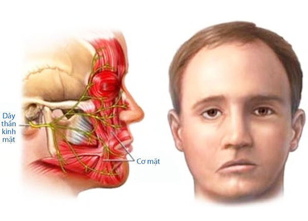Bệnh Co giật nửa mặt là tình trạng co giật một cách không chủ ý ở các cơ của 1 bên mặt (ảnh minh họa)