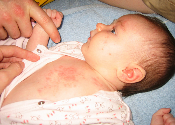 Bệnh ban đỏ ở trẻ em là bệnh hình thành khi cơ thể bị nhiễm nhóm khuẩn cầu chuỗi A (hình ảnh sưu tầm)