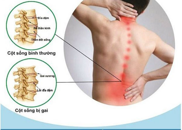 Bệnh gai cột sống có thể xuất hiện tại nhiều vị trí trên xương sống cơ thể