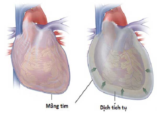 Nguyên nhân là do các vi khuẩn gây mủ, đặc biệt là tụ cầu vàng và phế cầu xâm nhập khoang màng tim