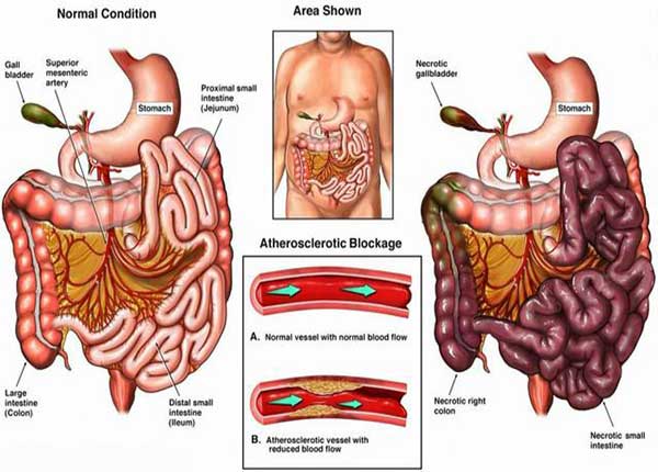 Nhồi máu mạc treo ruột có thể cấp tính hay mạn tính (ảnh minh họa)