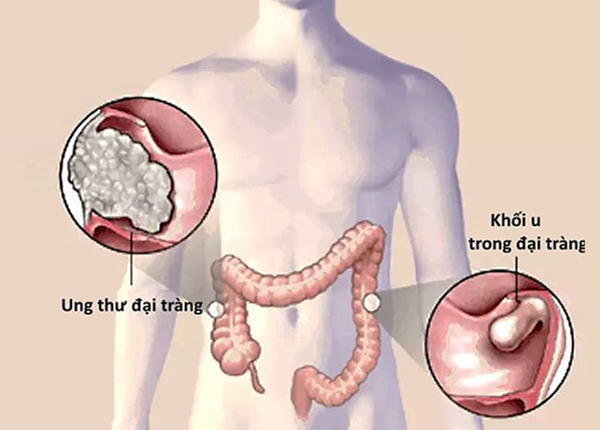 Ung thư đại tràng thường bắt đầu từ polyp được hình thành trong ruột già và trực tràng