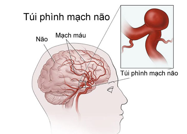 Phình mạch máu não là tình trạng các mạch máu não phình lên bất thường