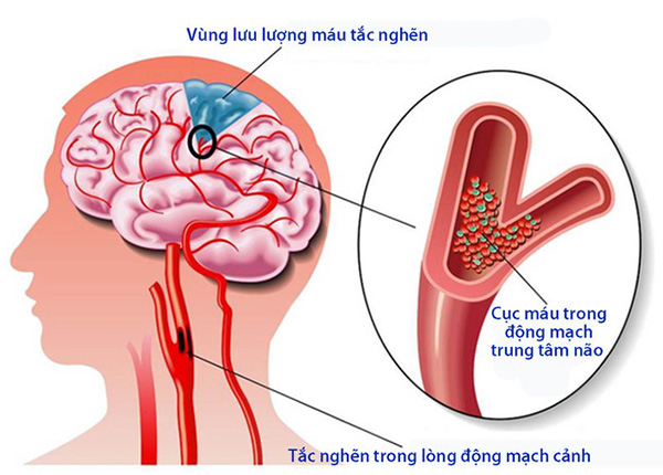 Tại biến mạch máu não là một trong 10 nguyên nhân gây tử vong hàng đầu hiện nay