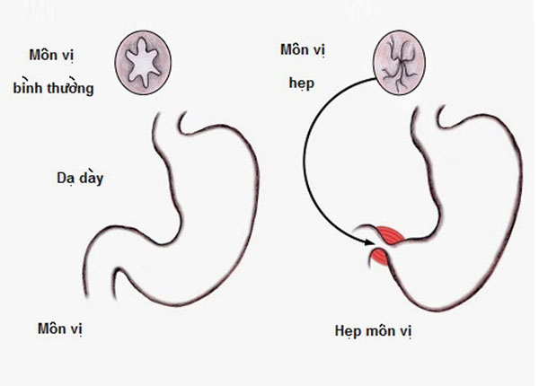 Bệnh hep môn vị (ảnh minh họa)