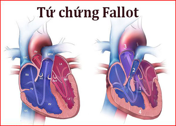 Tứ chứng Fallot là một trong những dị tật bẩm sinh phổ biến