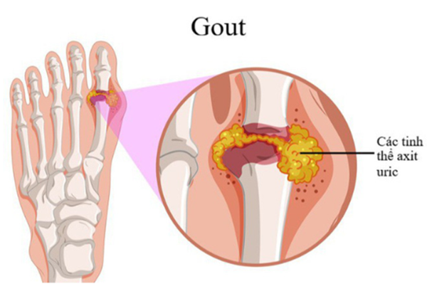 Bệnh gút là một bệnh gây rối loạn chuyển hoá