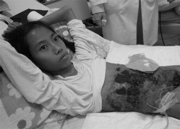 Sau phẫu thuật, Anh Nhi đã phải cắt toàn bộ đại tràng, toàn bộ buồng trứng, cắt một phần bàng quang và niệu quản.