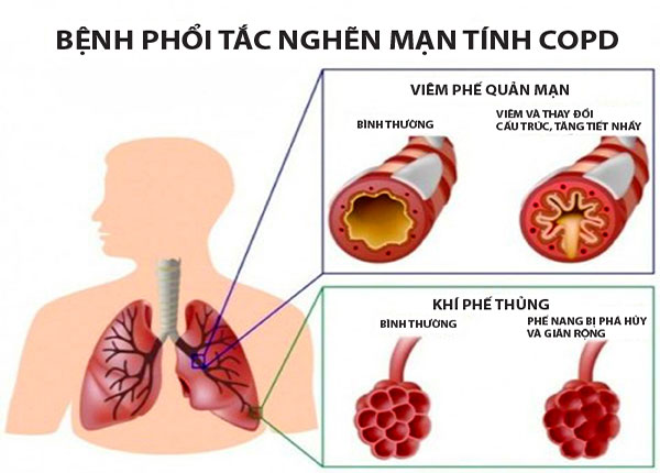 Dấu hiệu ban đầu của bệnh phổi tắc nghẽn mãn tính là ho, khạc đờm kéo dài