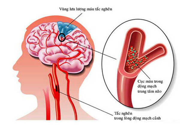 Bệnh xơ vữa động mạch