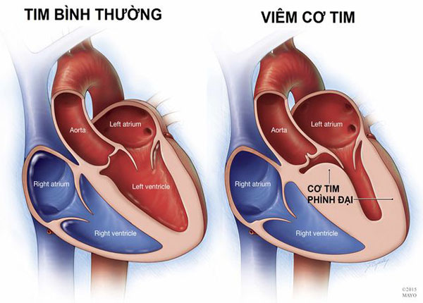 Bệnh viêm cơ tim thường xảy ra ở người trẻ tuổi