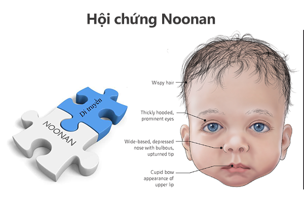 Hội chứng Noonan là một tình trạng rối loạn di truyền xảy ra từ khi mới sinh