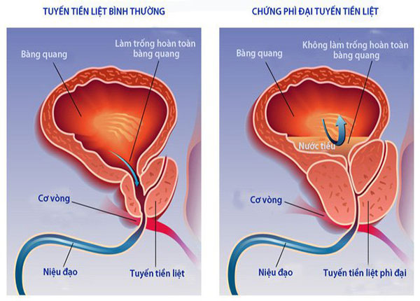 Phì đại tiền liệt tuyến thường gặp ở những người trung niên