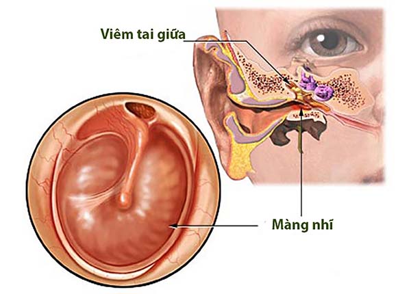 Bệnh viêm tai giữa