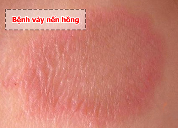 bệnh vảy nến hồng