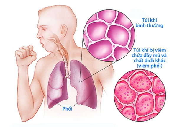 Bệnh viêm phổi