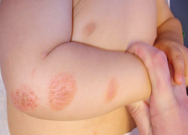 Bệnh nấm da ở trẻ em