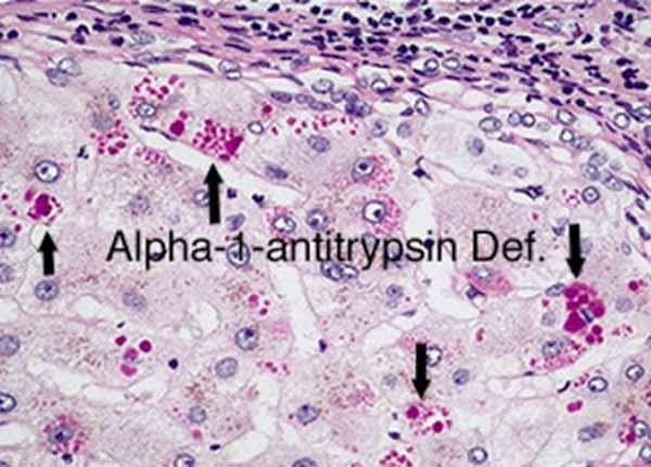 Suy giảm Alpha 1 antitrypsin
