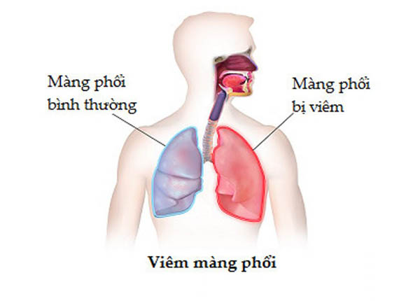 Bệnh viêm màng phổi